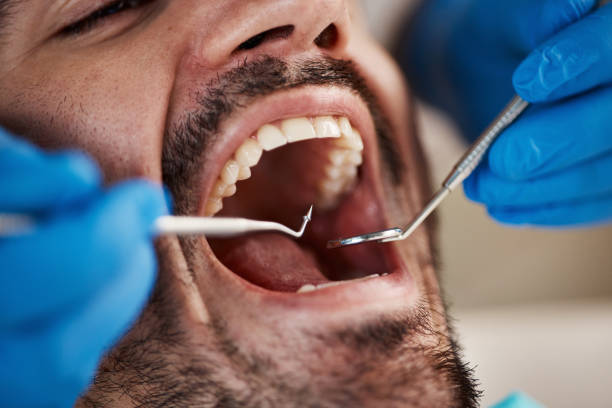 Best Emergency Wisdom Teeth Removal in Seneca Knolls, NY